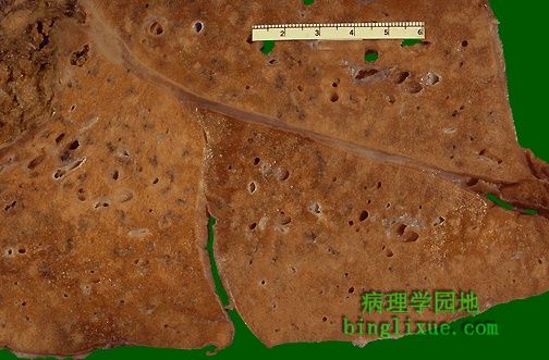 浸润型肺结核