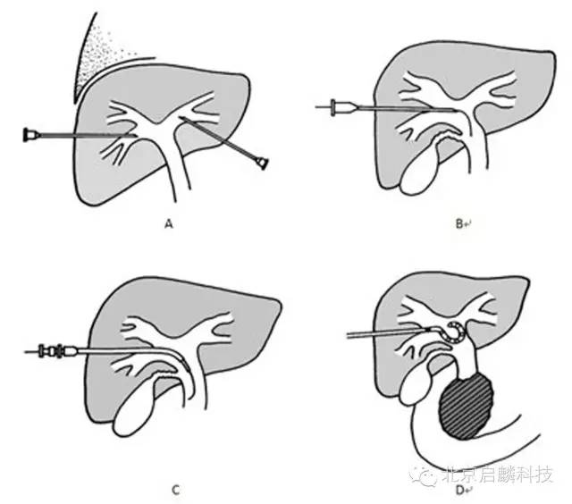 介入治疗适用于哪些癌症？_百科TA说