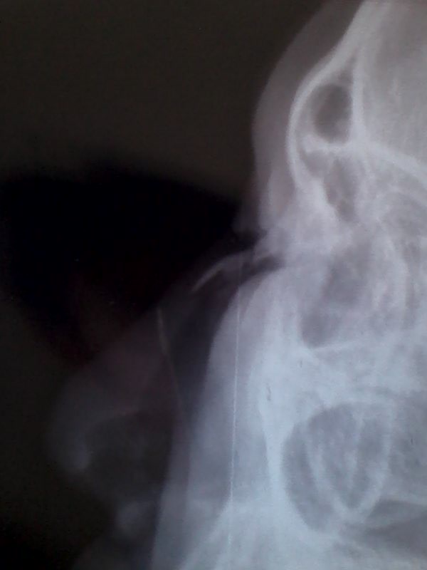  p> 鼻骨nasal bone位于鼻背的成对的小骨,长方