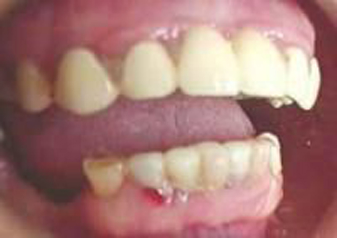  p>牙龈出血是 a target="_blank" href="/item/口腔科/3168128" data