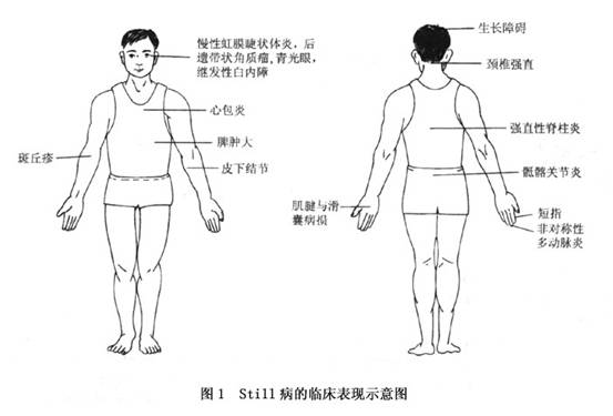 多发性慢性少年期关节炎