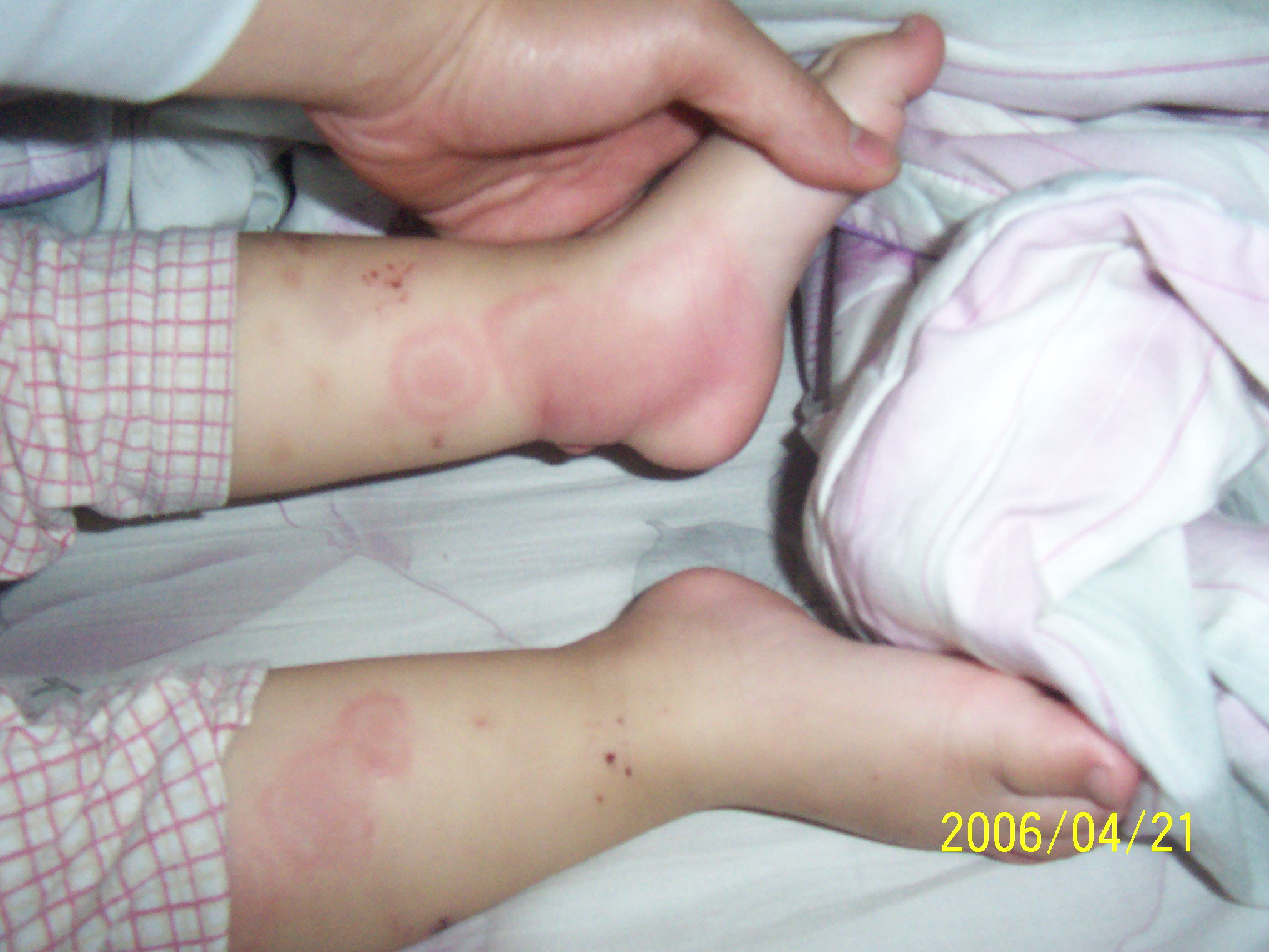 multiple chronic juvenile arthritis 是一种与成人类风湿关节炎健康