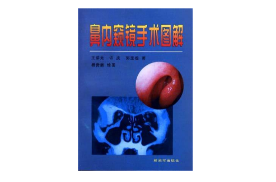 鼻内窥镜手术图解