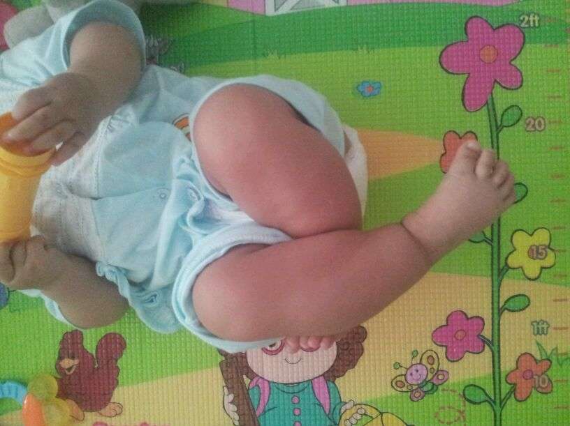 小儿夹腿综合症