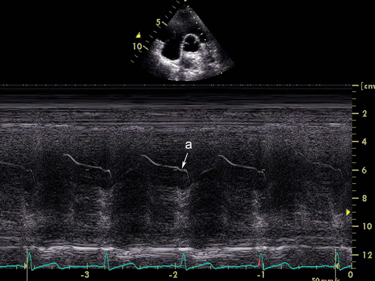 超声心动图是指应用超声短波测距原理脉冲超声波透过胸壁,软组织