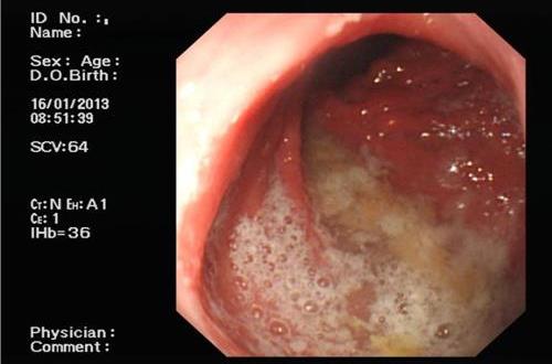  p>非萎缩性胃炎是一种由多种病因引起的胃粘膜慢性炎症.