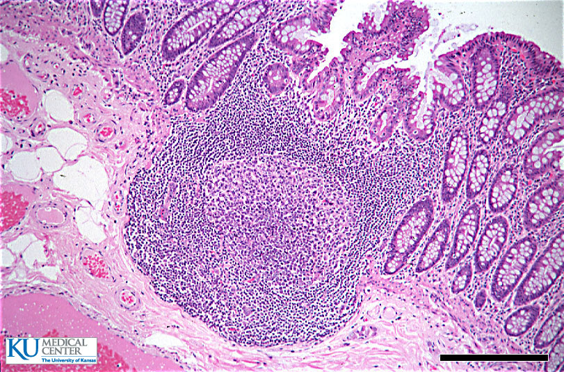 派尔集合淋巴结