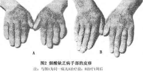 糙皮病