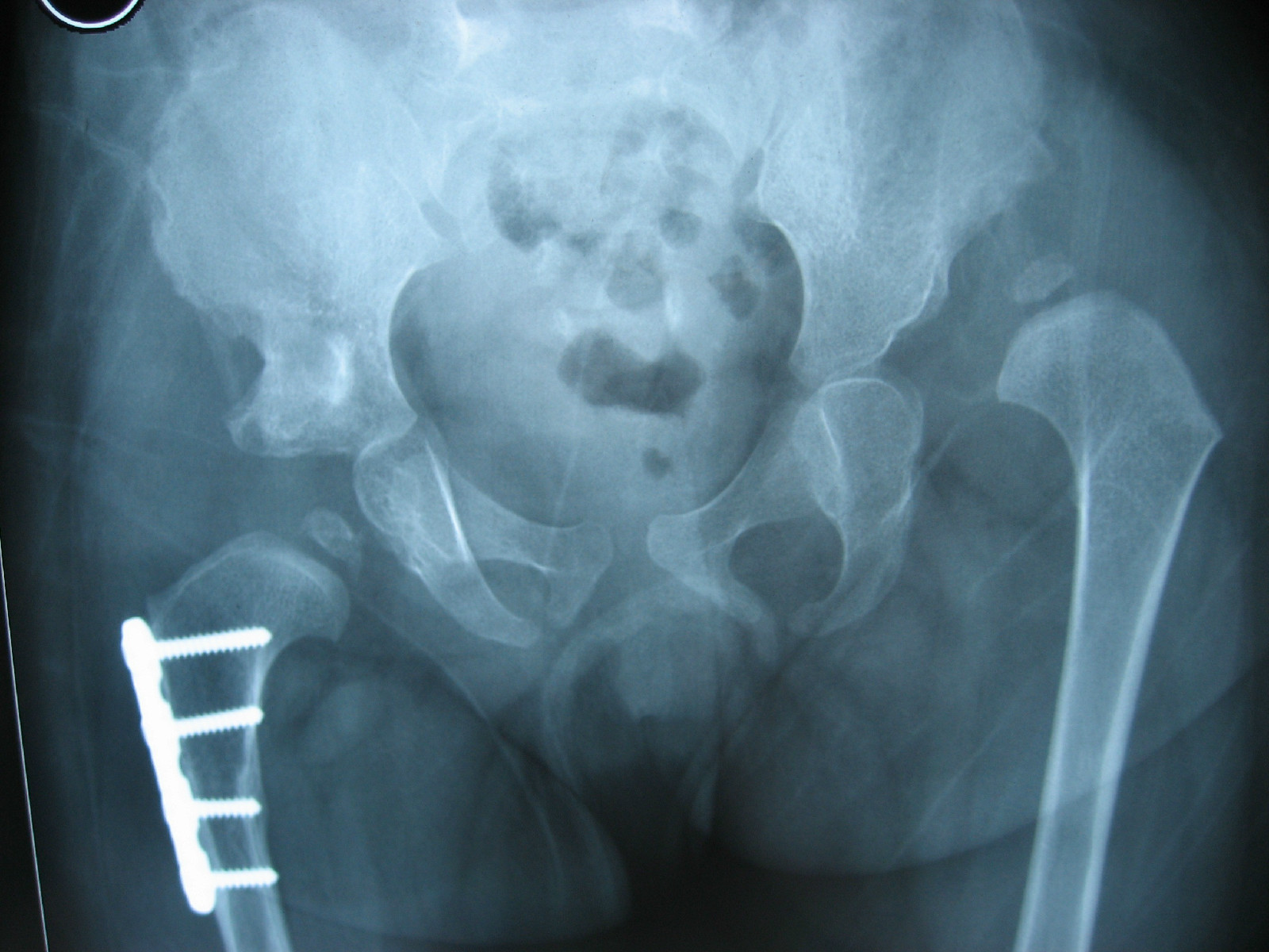 ddh包括髋关节脱位,半脱位和髋臼发