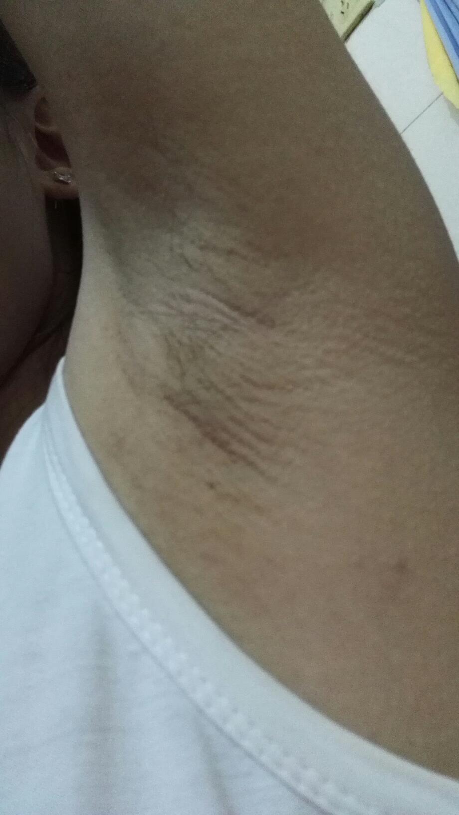 腋毛变稀少