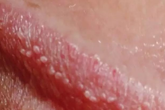 珍珠样阴茎丘疹