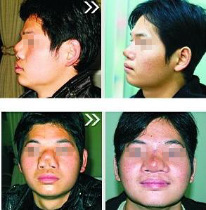  p>畸形鼻是指鼻子产生歪曲,倾斜,缺失,明显不对称等,和常人的鼻子有