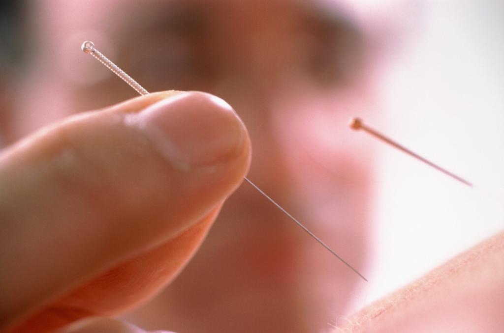 针灸疗法