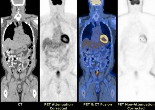 PET-CT_百度百科
