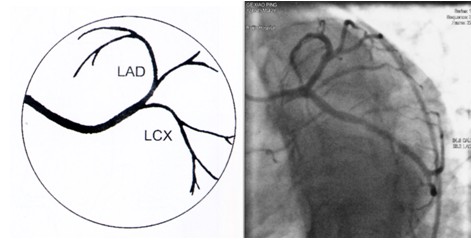 冠状动脉造影是诊断冠状动脉粥样硬化性心脏病(冠心病)的一种常用而且