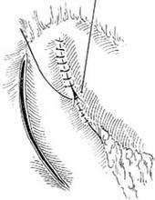 马蹄形切开式幽门成形术