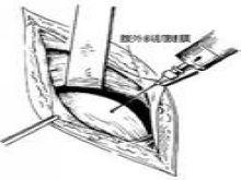  p>     a target="_blank" href="/item/髂窝脓肿/3817661" data