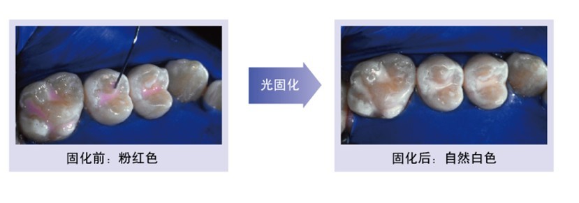  p>3m窝沟封闭剂也就是clinprotmsealant 变色窝沟封闭剂,主要用于窝