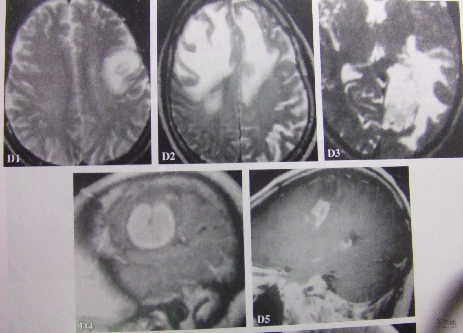  p>旋毛虫 a href="#" data-lemmaid="2697752">幼虫寄生 /a>于肌纤维