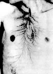  p>皮肤金属化(electric metalization of the skin)或称金属异物沉积