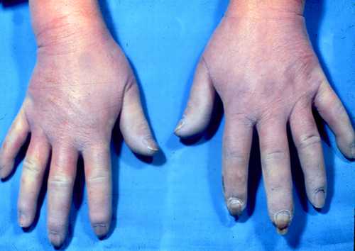  p> a target="_blank" href="/item/雷诺现象/3526967" data-lemmaid