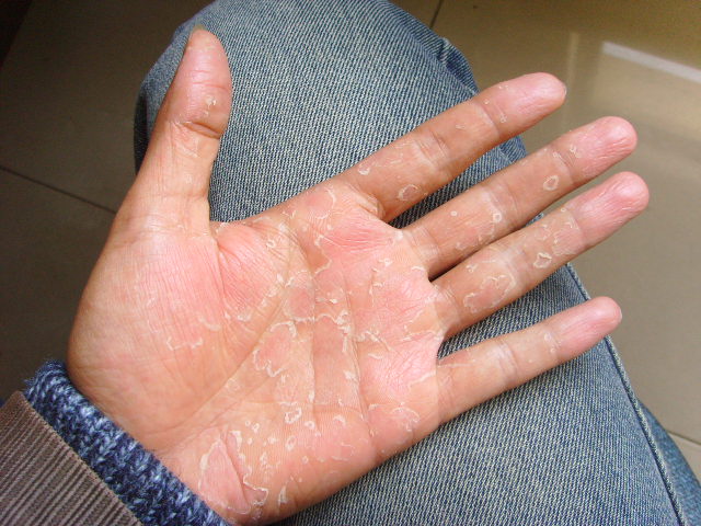  p>手干裂俗称手裂子,是由于(手)皮肤表面的油膜 a href="#" data