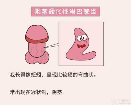 阴茎硬化淋巴管炎