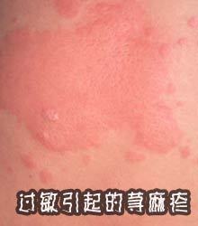 过敏反应（生理反应）_百度百科
