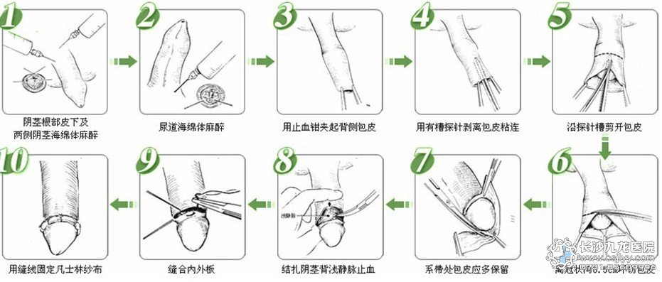 正常包皮长度(男性正常包皮长度)