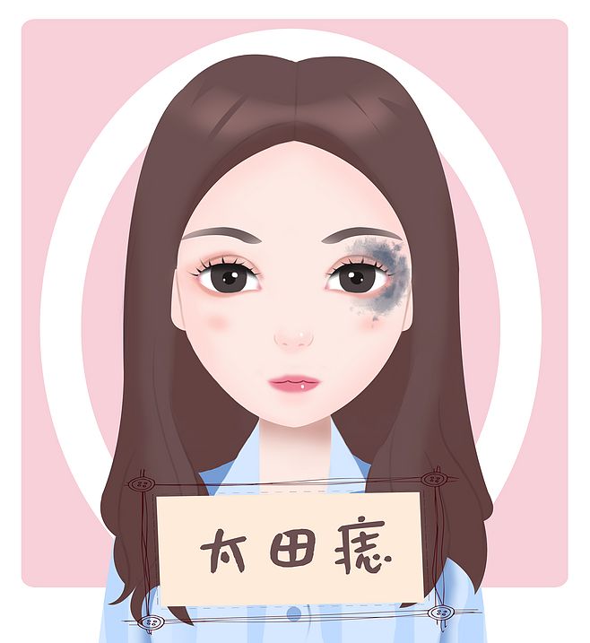 青色胎记