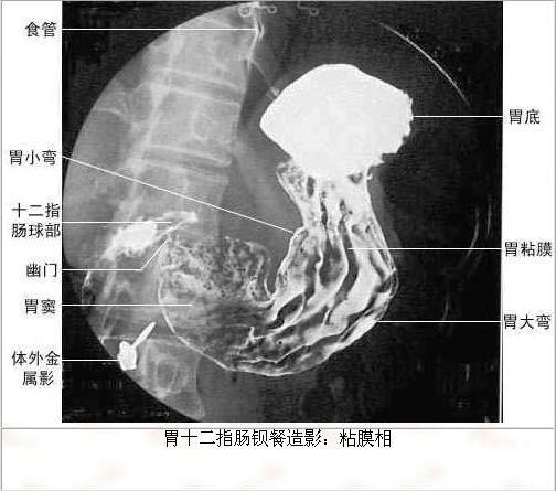 病人在进行胃镜检查前,食入钡餐,钡餐在含有盐酸的胃酸中不会溶解