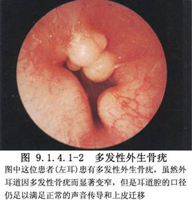 外耳道良性肿瘤切除术