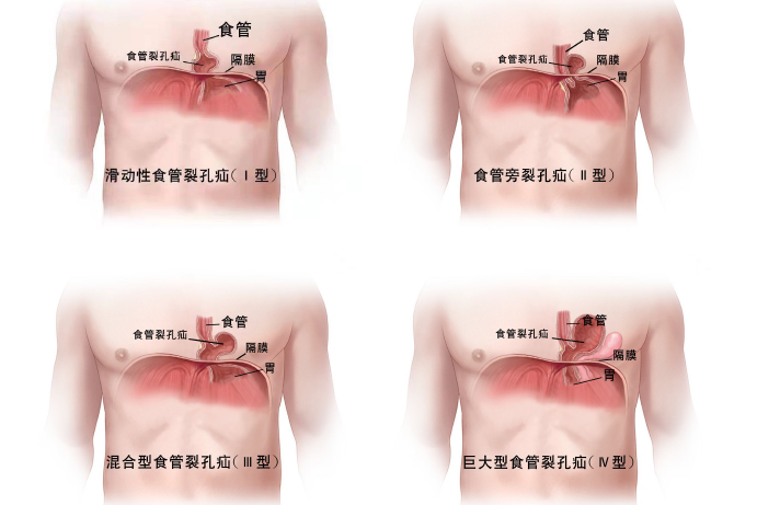 食管裂孔疝
