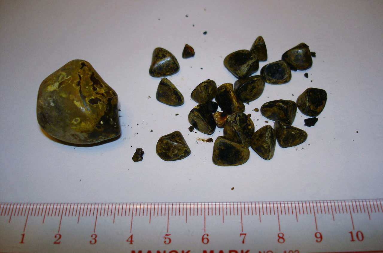 胆囊泥沙样结石