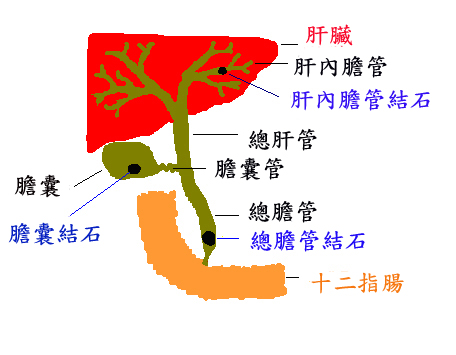 胆结石中药方剂