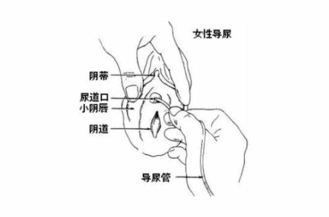  p>医学上,经由尿道插入导尿管到膀胱,引流出尿液.