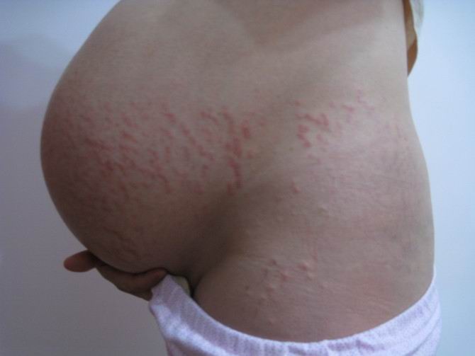  p>中文名:妊娠瘙痒性荨麻疹性丘疹及斑块病或妊娠瘙痒性荨麻疹样丘疹