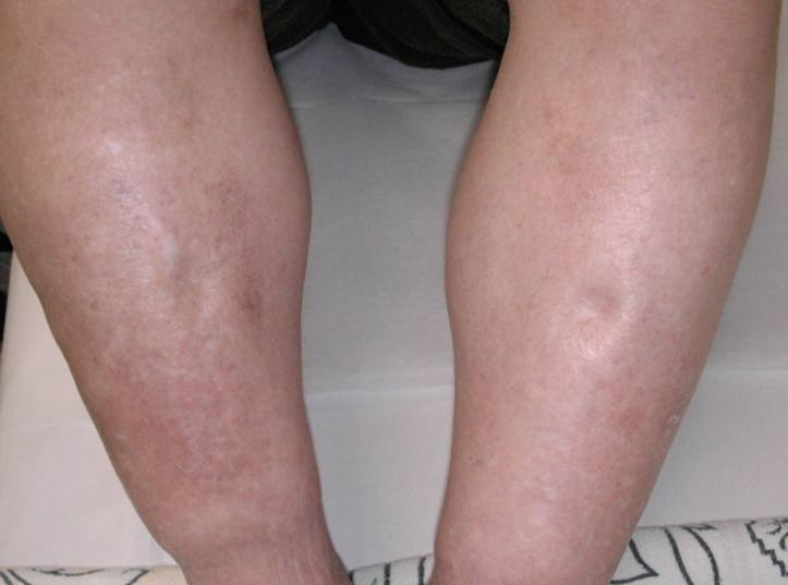 辨别水肿腿,肌肉腿,脂肪腿,手感很硬是肌肉的,很软是脂肪的,水肿是按