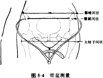  p>髂棘间径(interspinal diameter,is),或称为髂前棘间宽,髂前上棘间