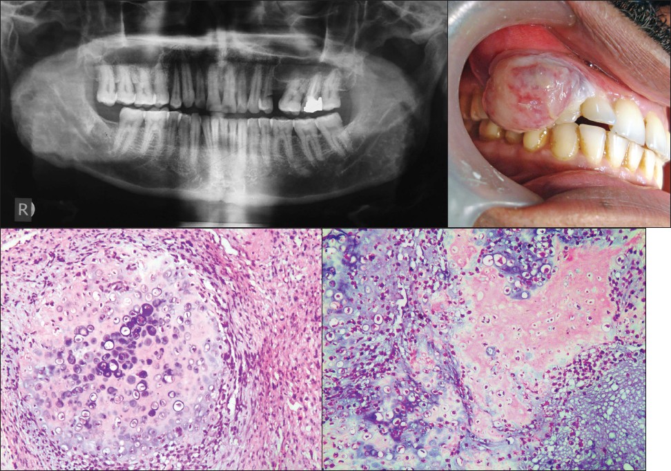  p>骨肉瘤是恶性度较高的肿瘤,约有5%发生于颌骨,下颌骨较上颌骨为多