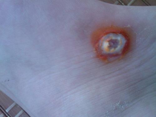  p>跖疣是发生在足跟,跖骨头或跖间的寻常疣,是由乳头瘤病毒所引起的