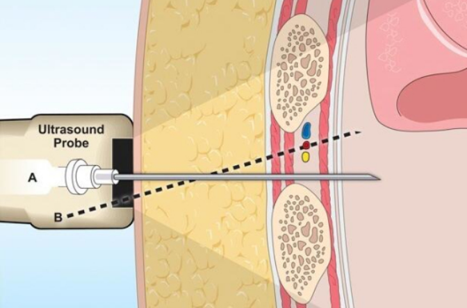  p>胸腔穿刺是指用消毒过的针刺经 a target="_blank" href="/item