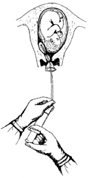  p>中期妊娠引产法是指妇女在怀孕14―24周之间人工终止妊娠的方法.