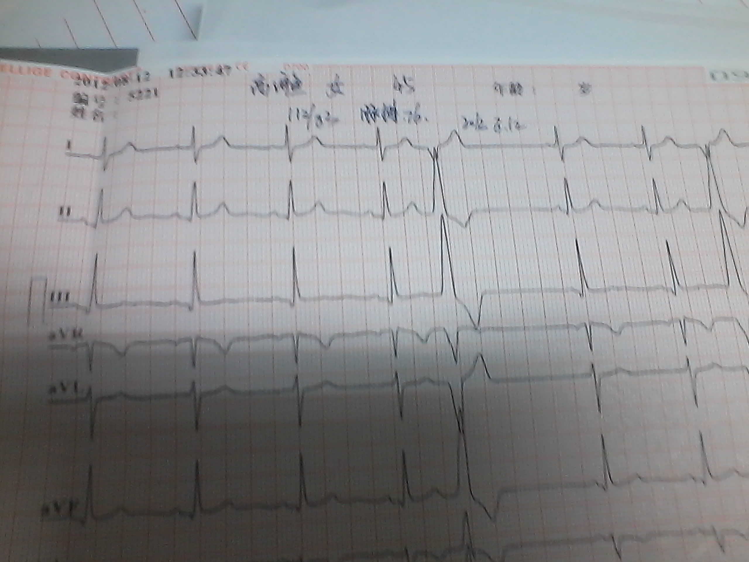频发性室性早搏