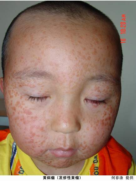 迟发性皮肤卟啉病