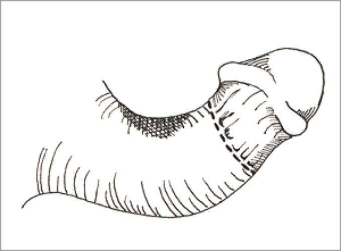 弯曲在医学学名上称之为"阴茎 a target="_blank" href="/item/海绵体