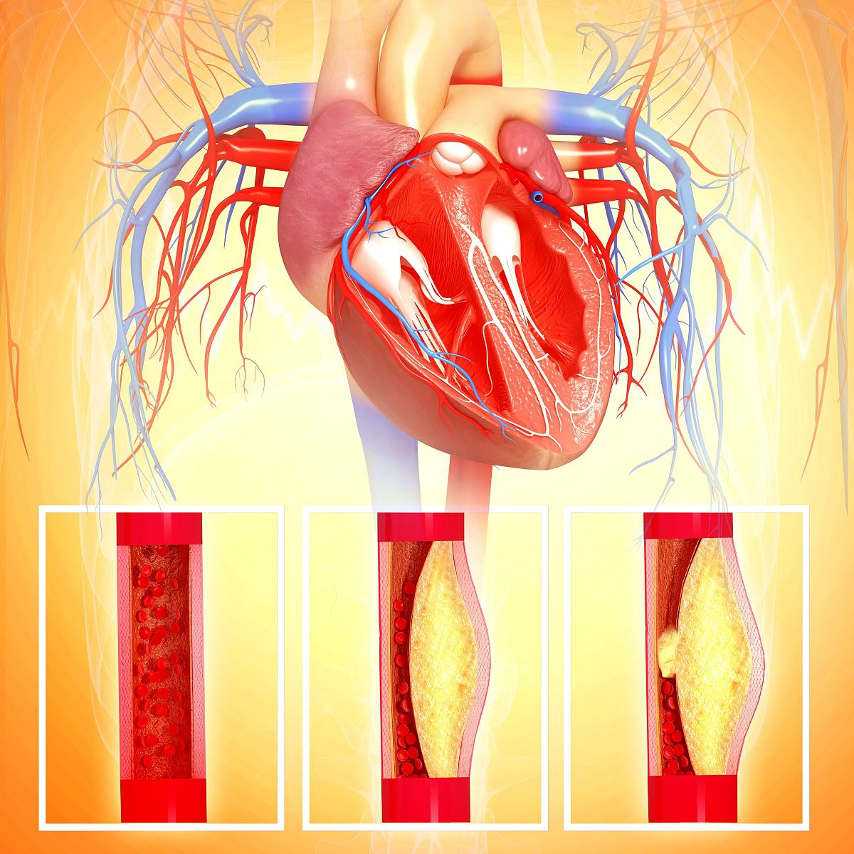 主动脉粥样硬化