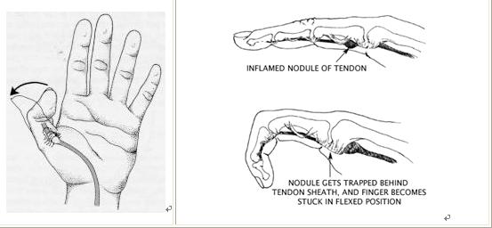  p>弹弓指,又叫扳机指(trigger finger) 是一种 a target="_blank"