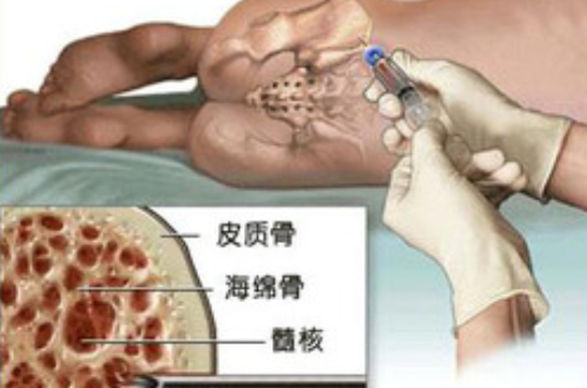  p>胶原酶介入溶解术,亦称胶原酶溶核术是在c型臂x线机,ct引导下,将