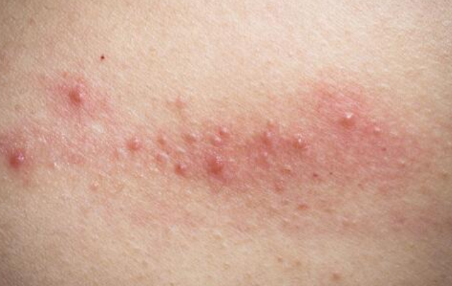  p data-id="gncnunkijm">肛周瘙痒是一种常见的局限性神经机能障碍性